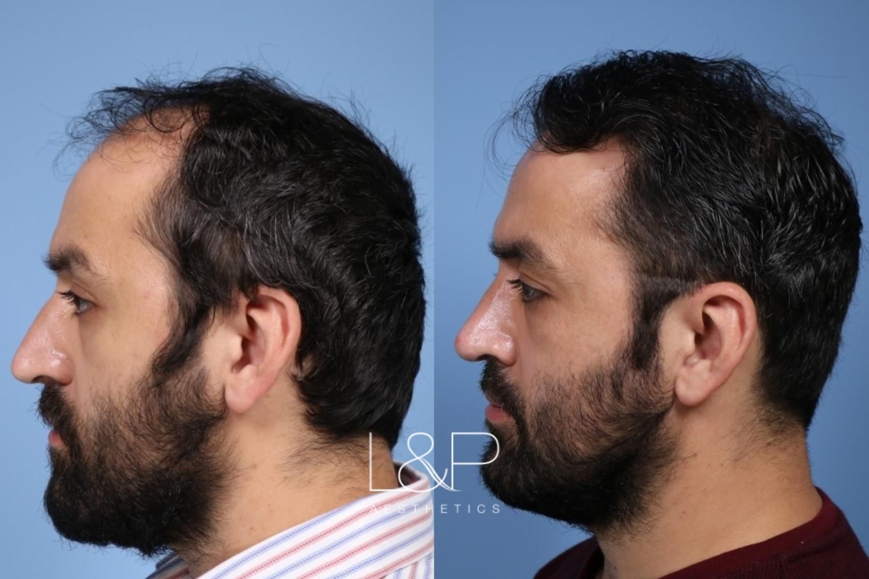 Rhinoplasty before and after treatment in California