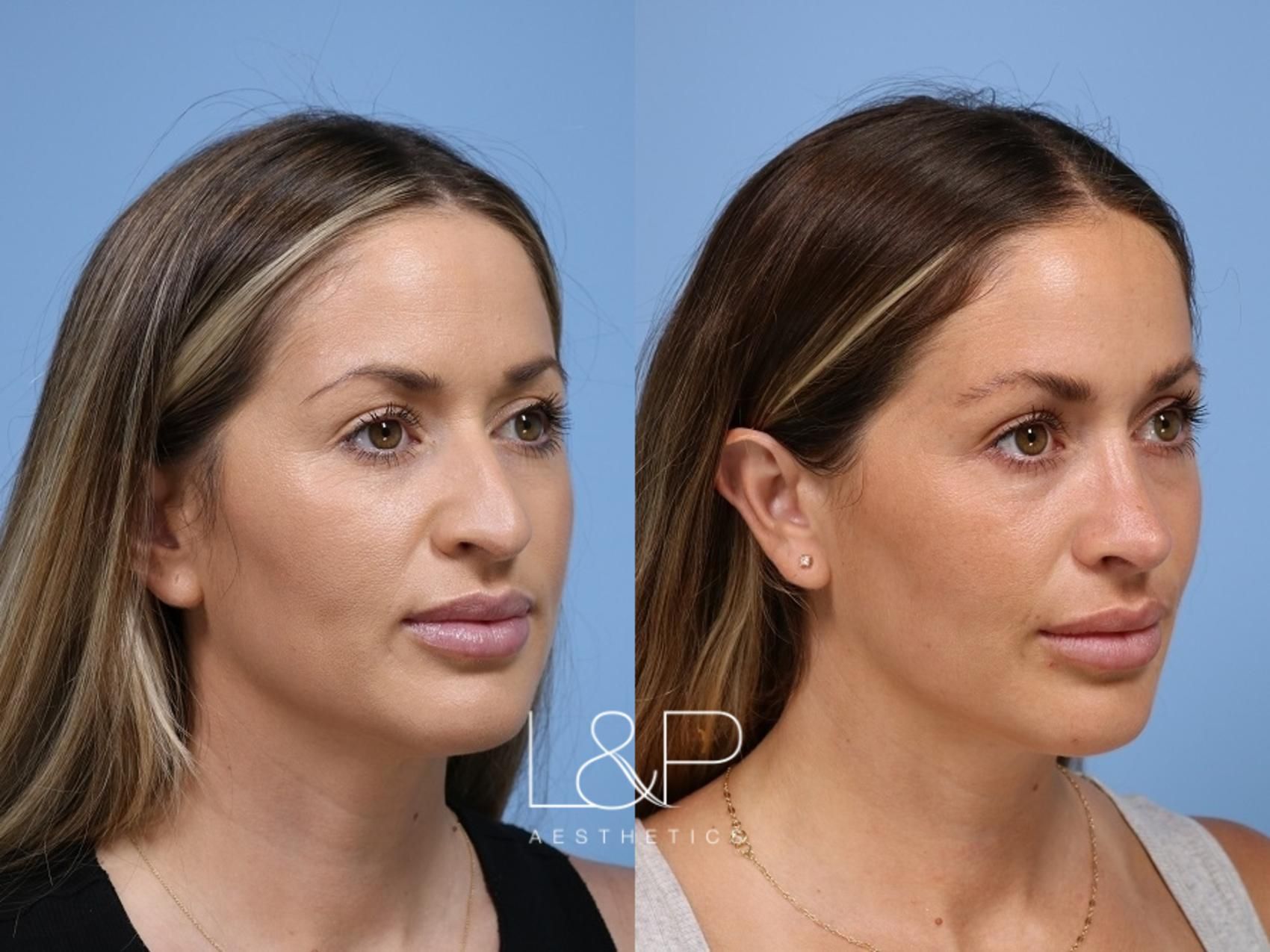 Rhinoplasty before and after treatment in Palo Alto, California