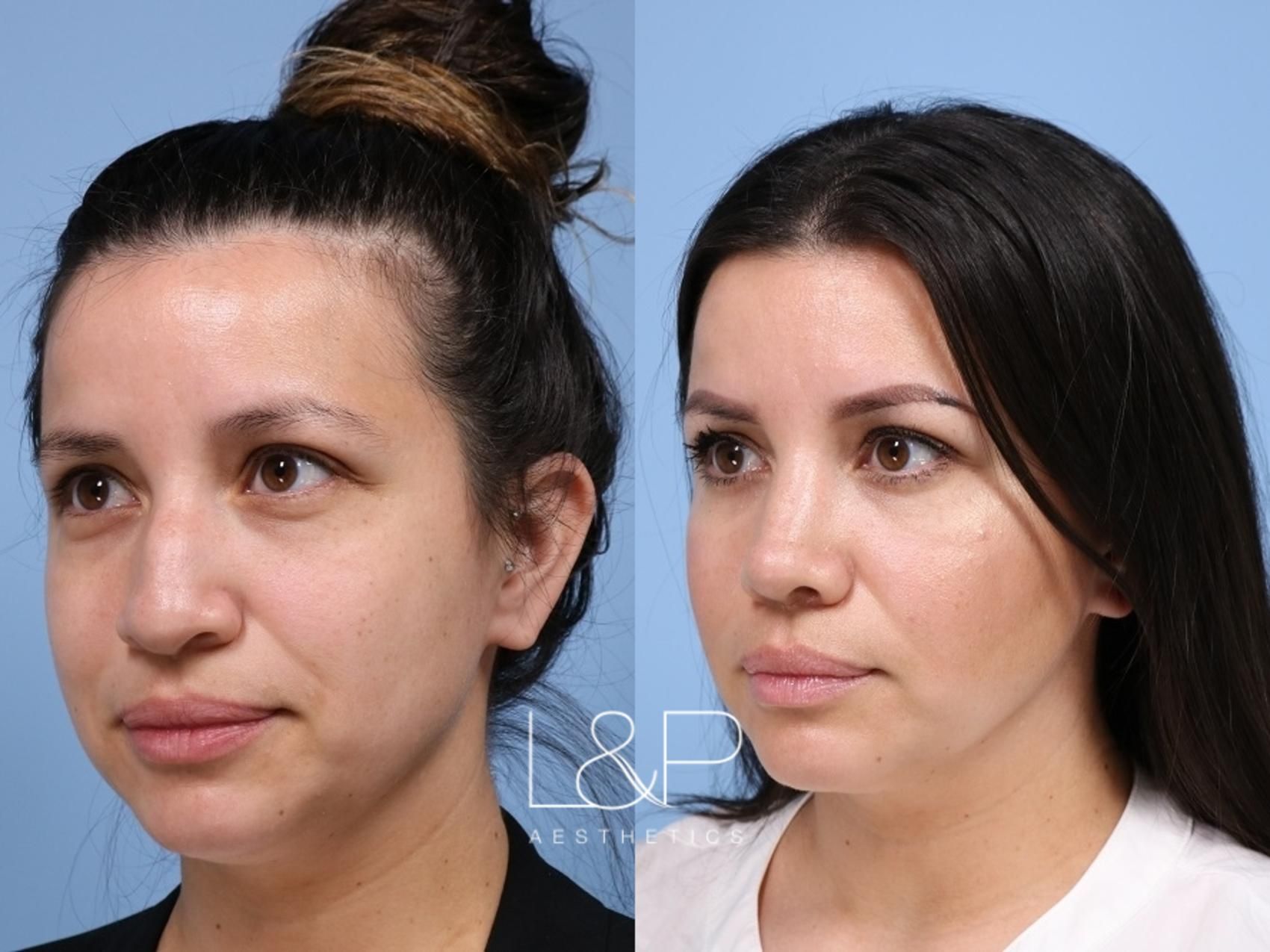 Rhinoplasty before and after treatment in the Bay Area