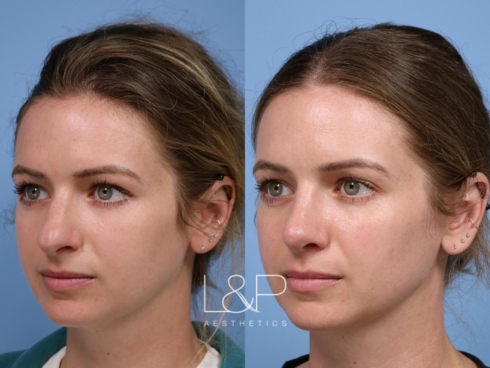 Rhinoplasty before and after treatment in Los Gatos, CA