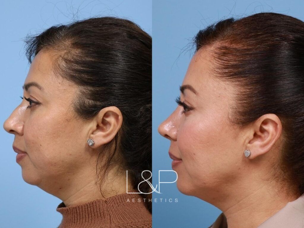 Full Face Contouring Before & After Photo Gallery, San Francisco, CA