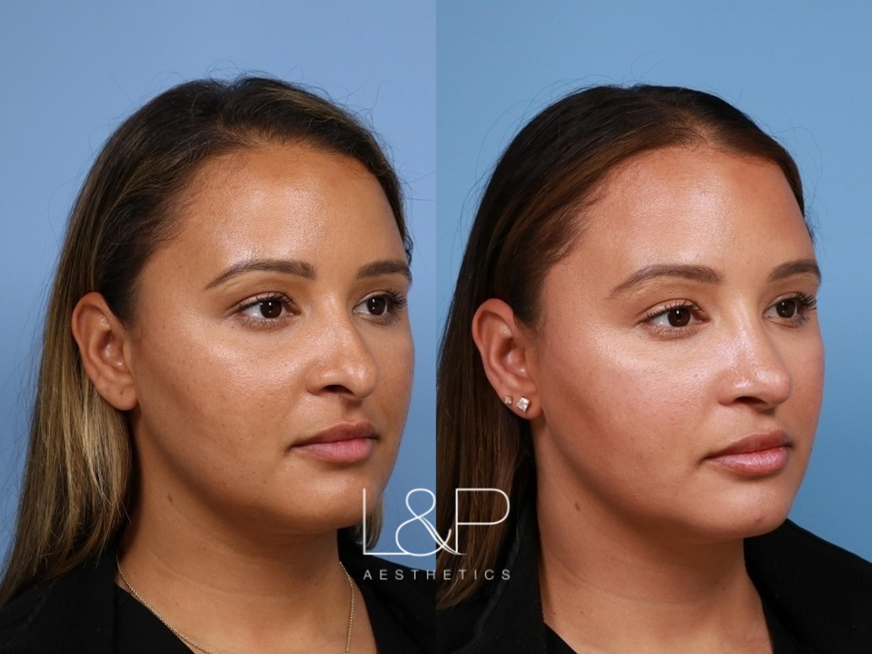 Rhinoplasty before and after treatment in California