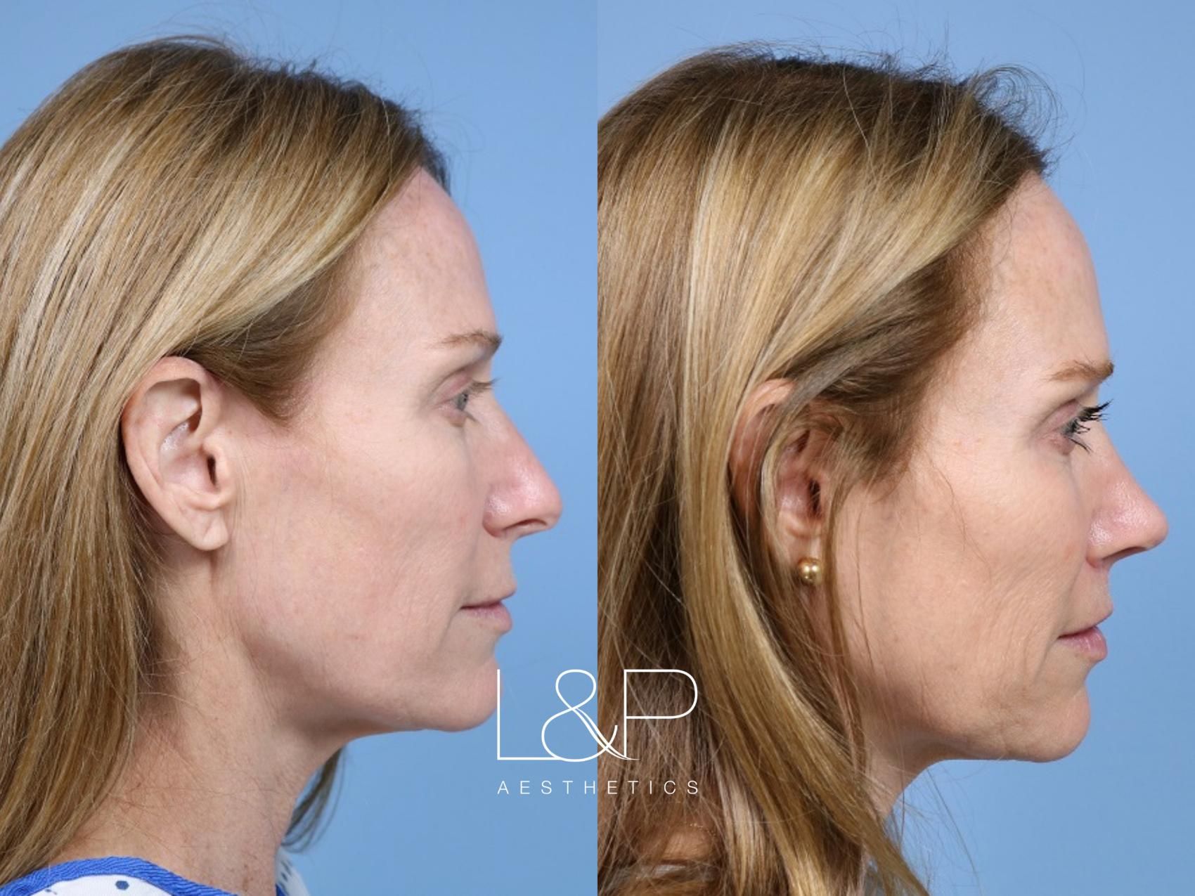 Rhinoplasty before and after treatment in Los Gatos, California