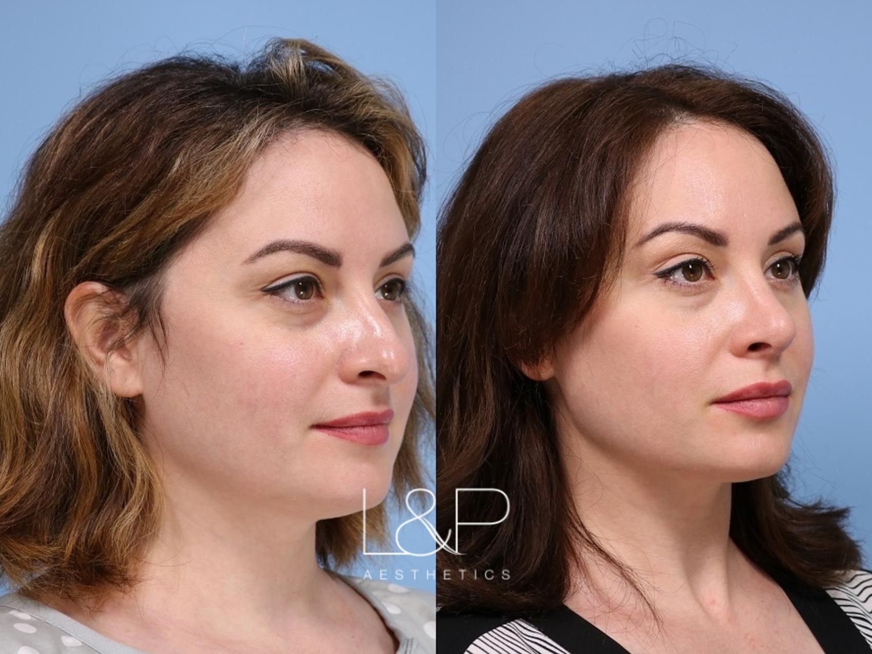 Rhinoplasty before and after treatment in Los Gatos, California