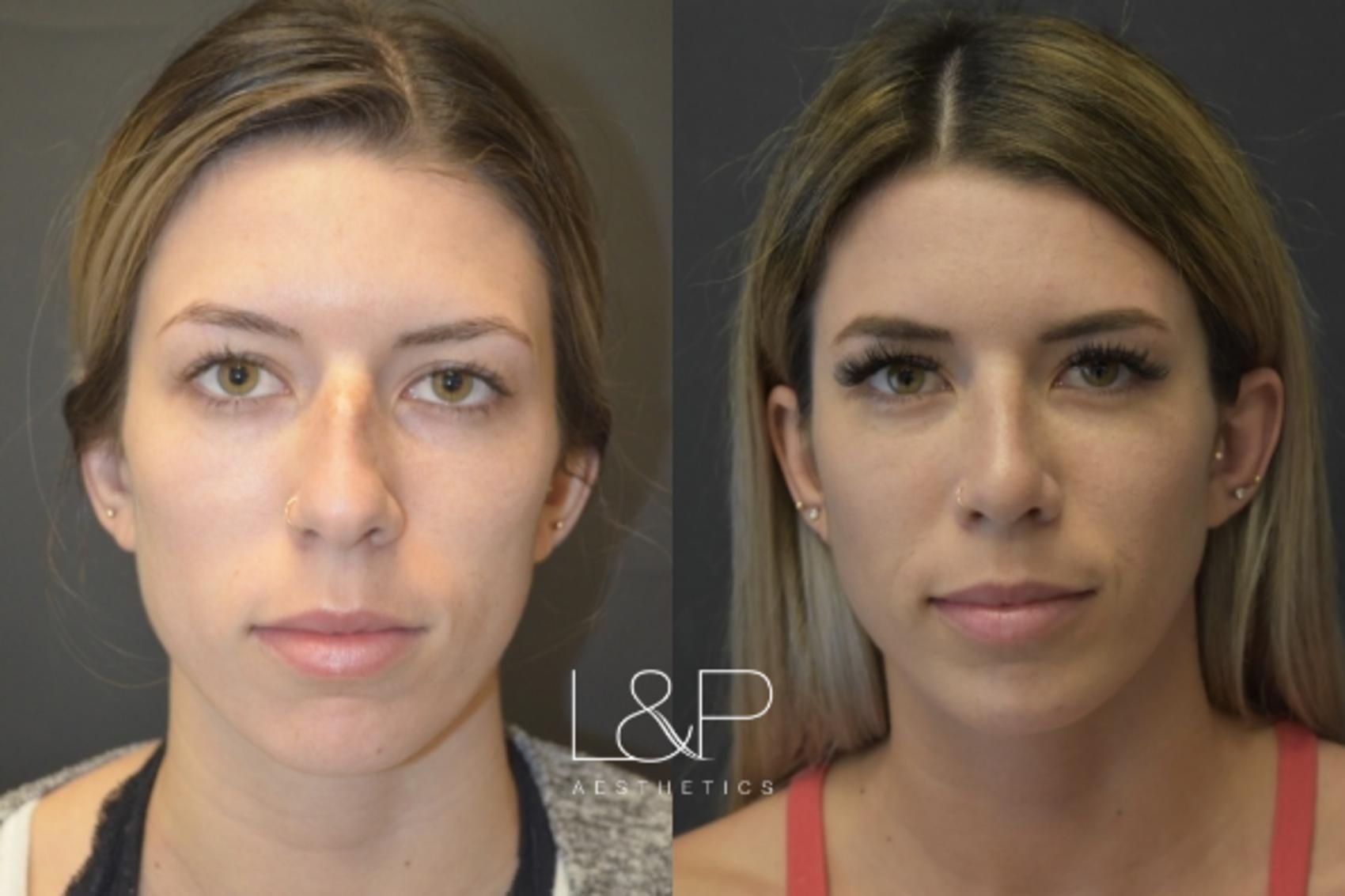 Rhinoplasty before and after treatment in Los Gatos, CA