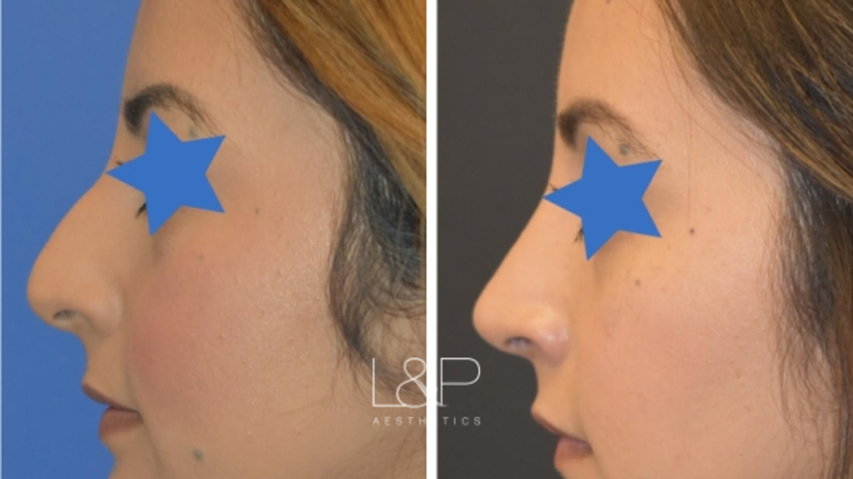 Rhinoplasty before and after treatment