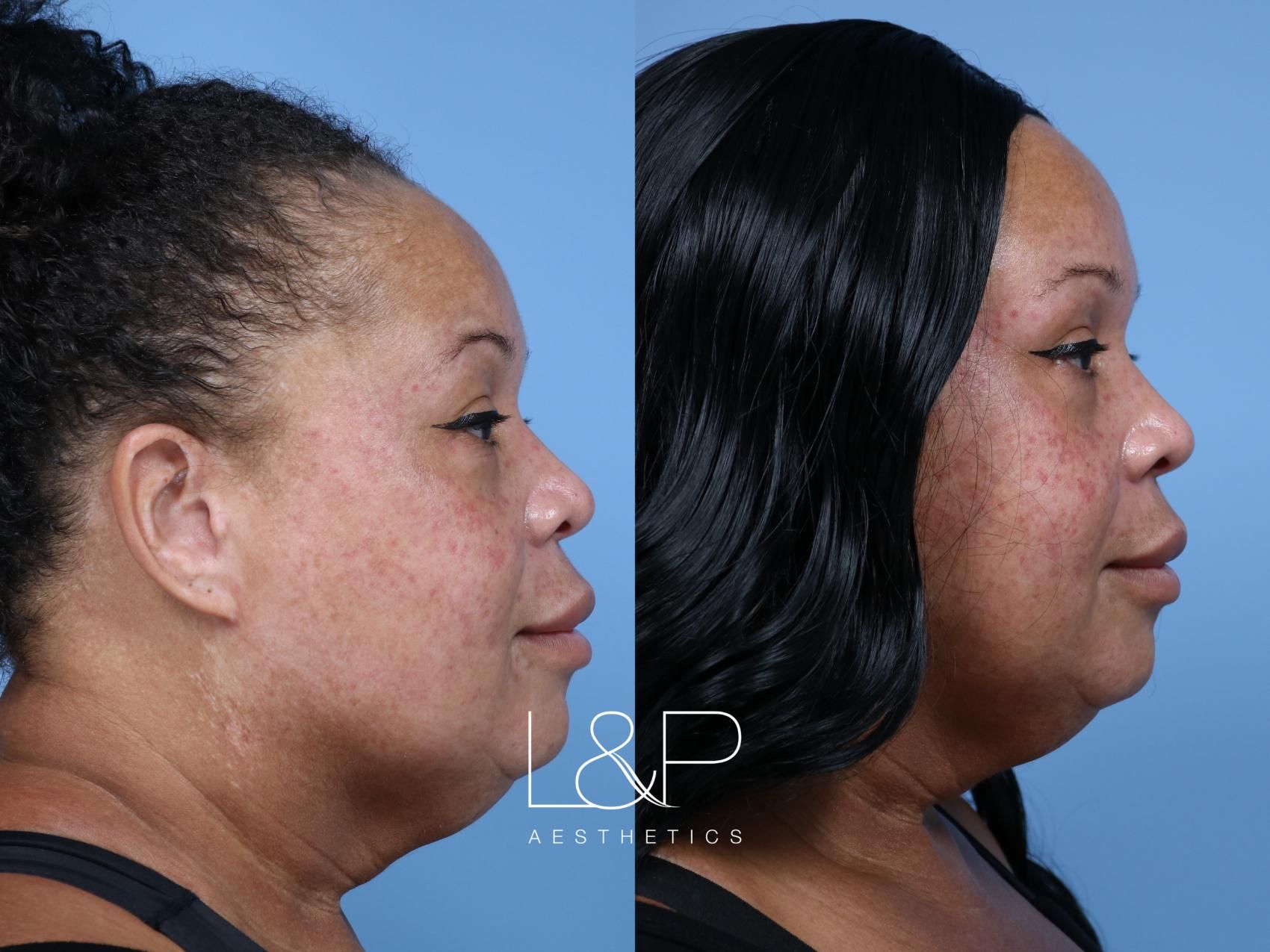 Ultherapy before and after treatment