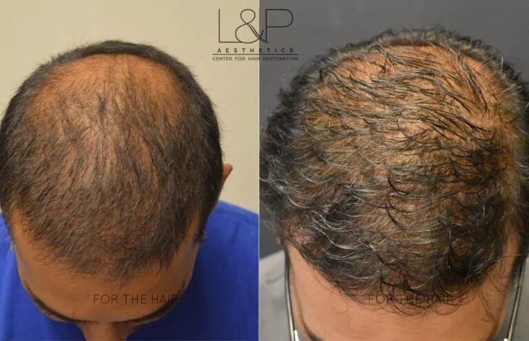 Hair Restoration before and after treatment