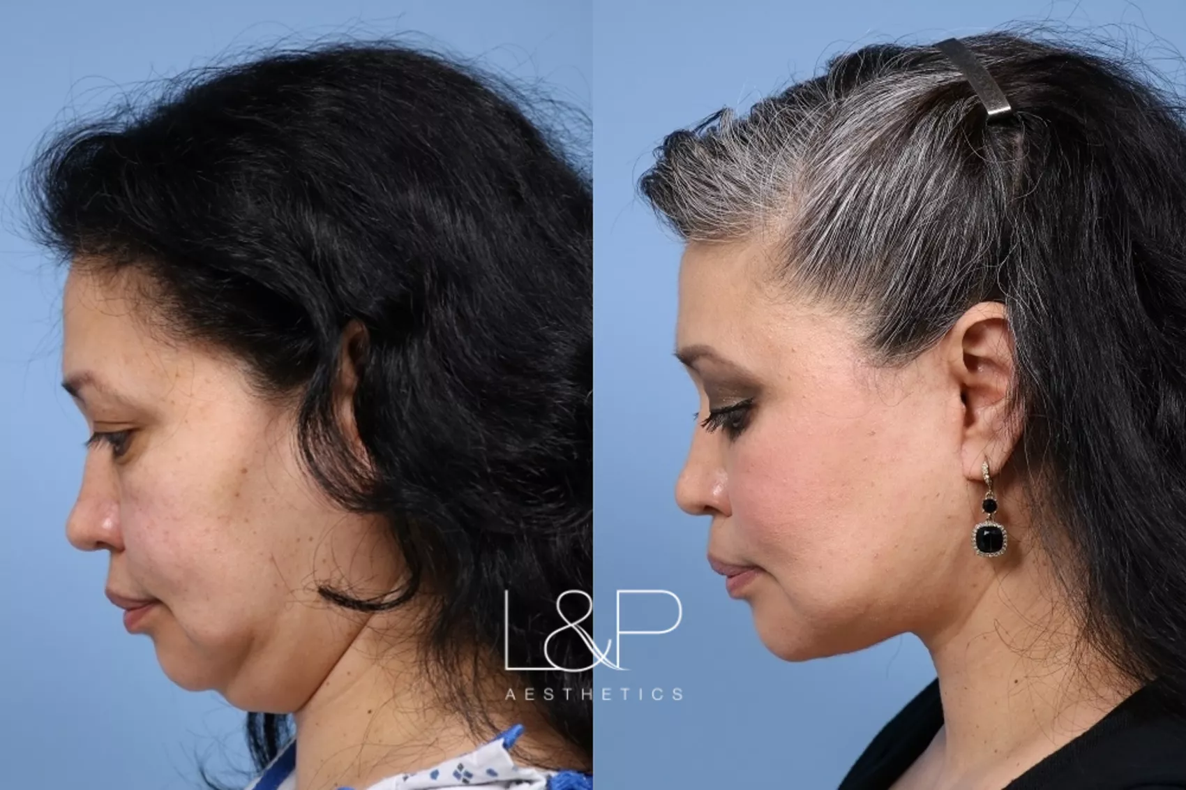 facelift-neck-lift-279-chin-view-detail
