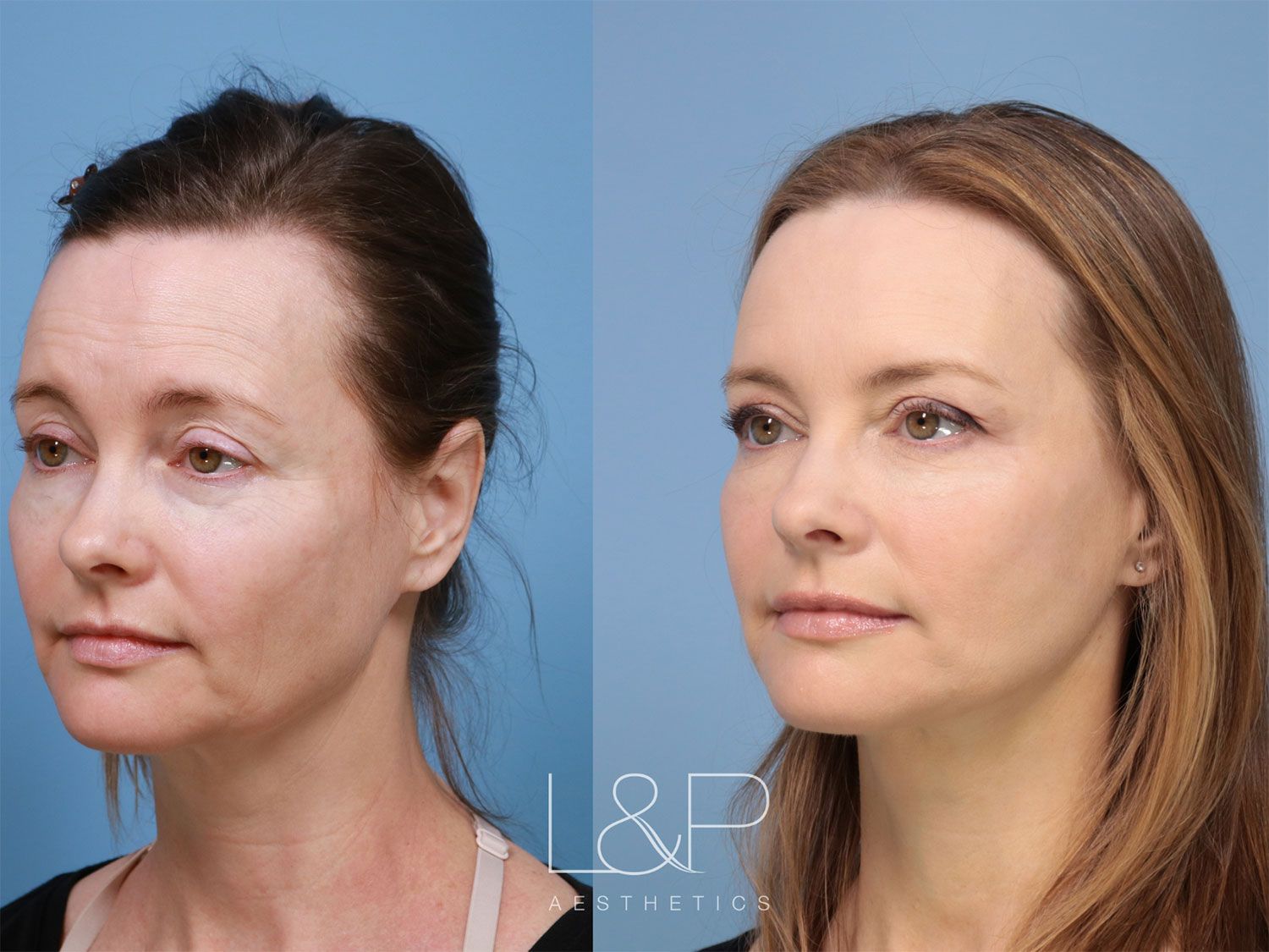 Beautiful before and after facelift in California