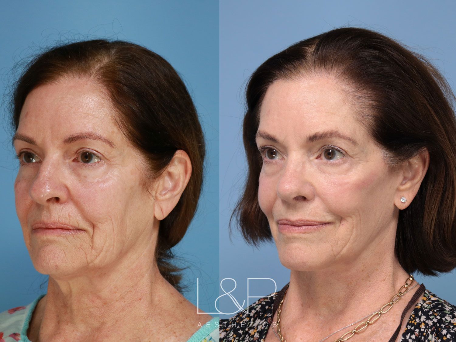 Before and after facelift in Palo Alto, CA - Natural looking facelift results