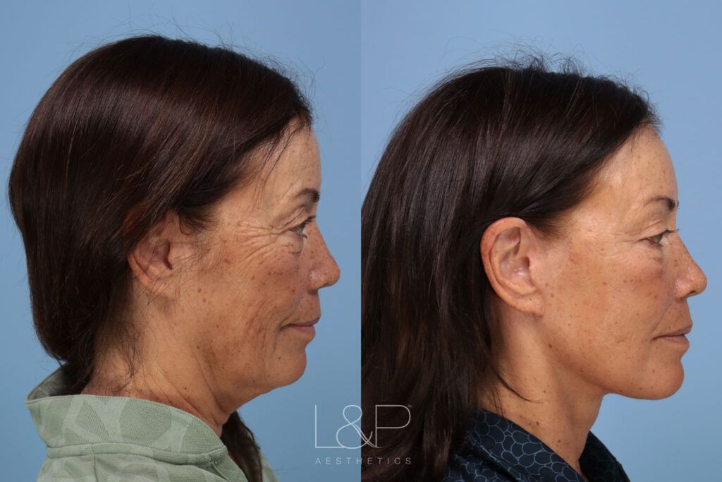 Woman with facelift from L&P Aesthetics looking left