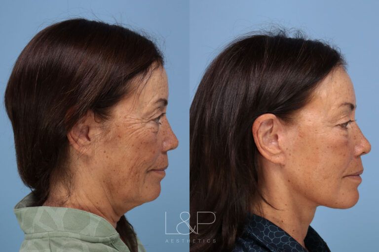 Woman with facelift from L&P Aesthetics looking left