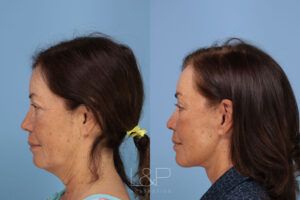 Before and after of a mini facelift & L&P Aesthetics