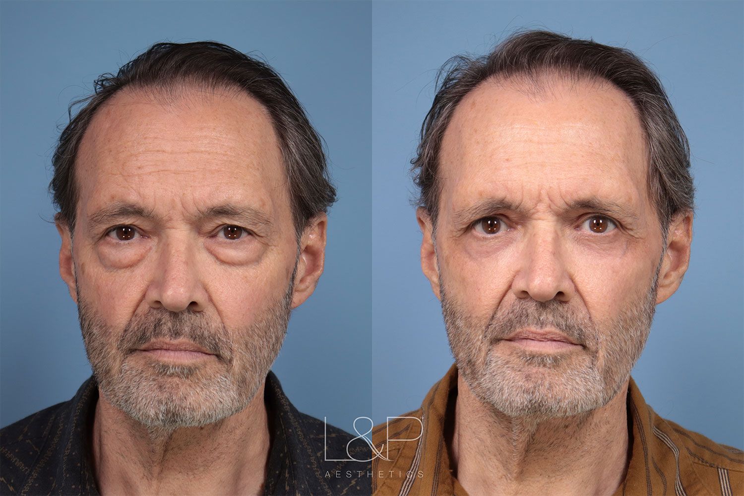 Before and After Male Blepharoplasty in Palo Alto, CA