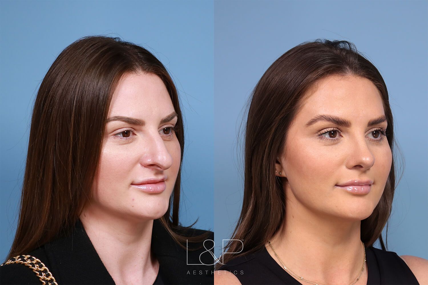 Before and After Rhinoplasty in Palo Alto, CA