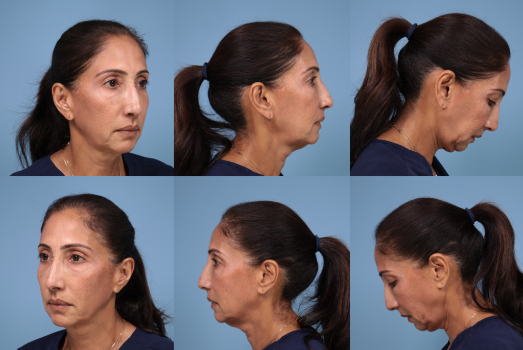 Patient looking in 6 different directions, as per the instructions