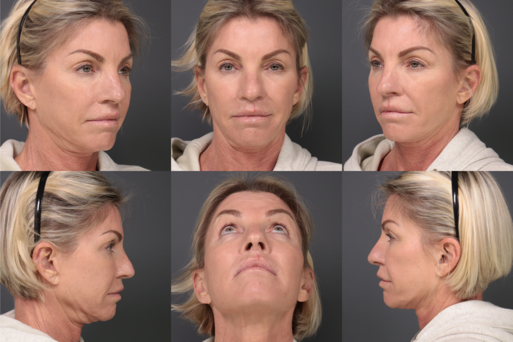 Woman who had a rhinoplasty in Palo Alto, CA at L&P Aesthetics