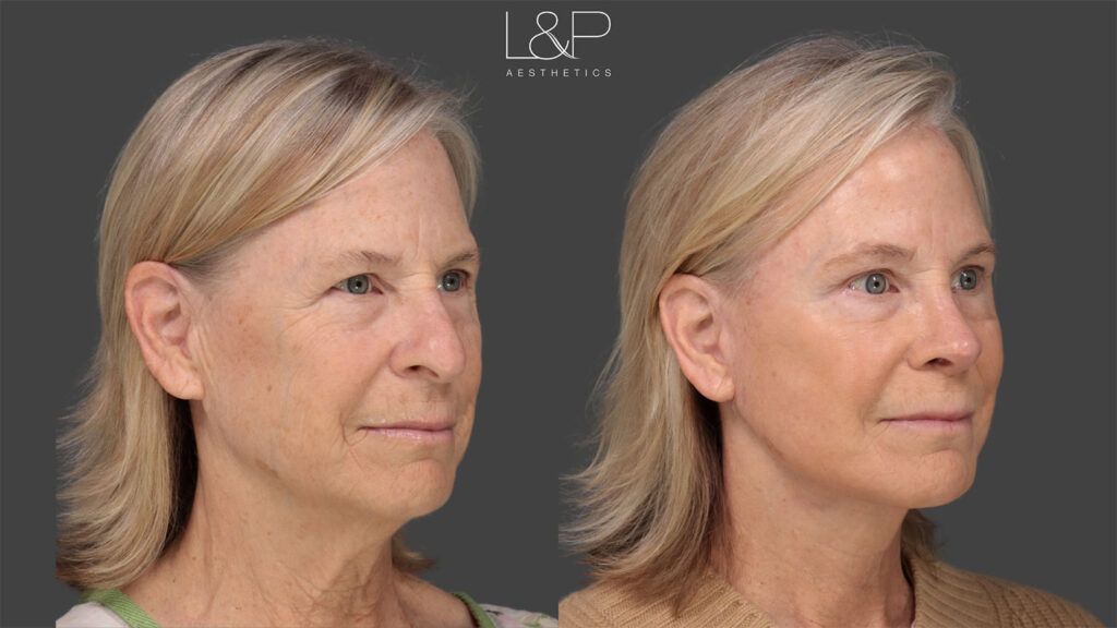 Woman with a facelift by Drs. L&P looking left