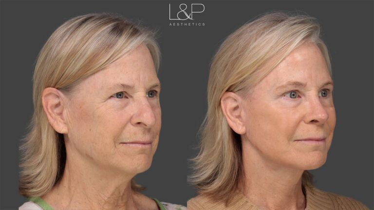 Woman with a facelift by Drs. L&P looking left