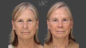 L&P Aesthetics facelift before and after images side by side
