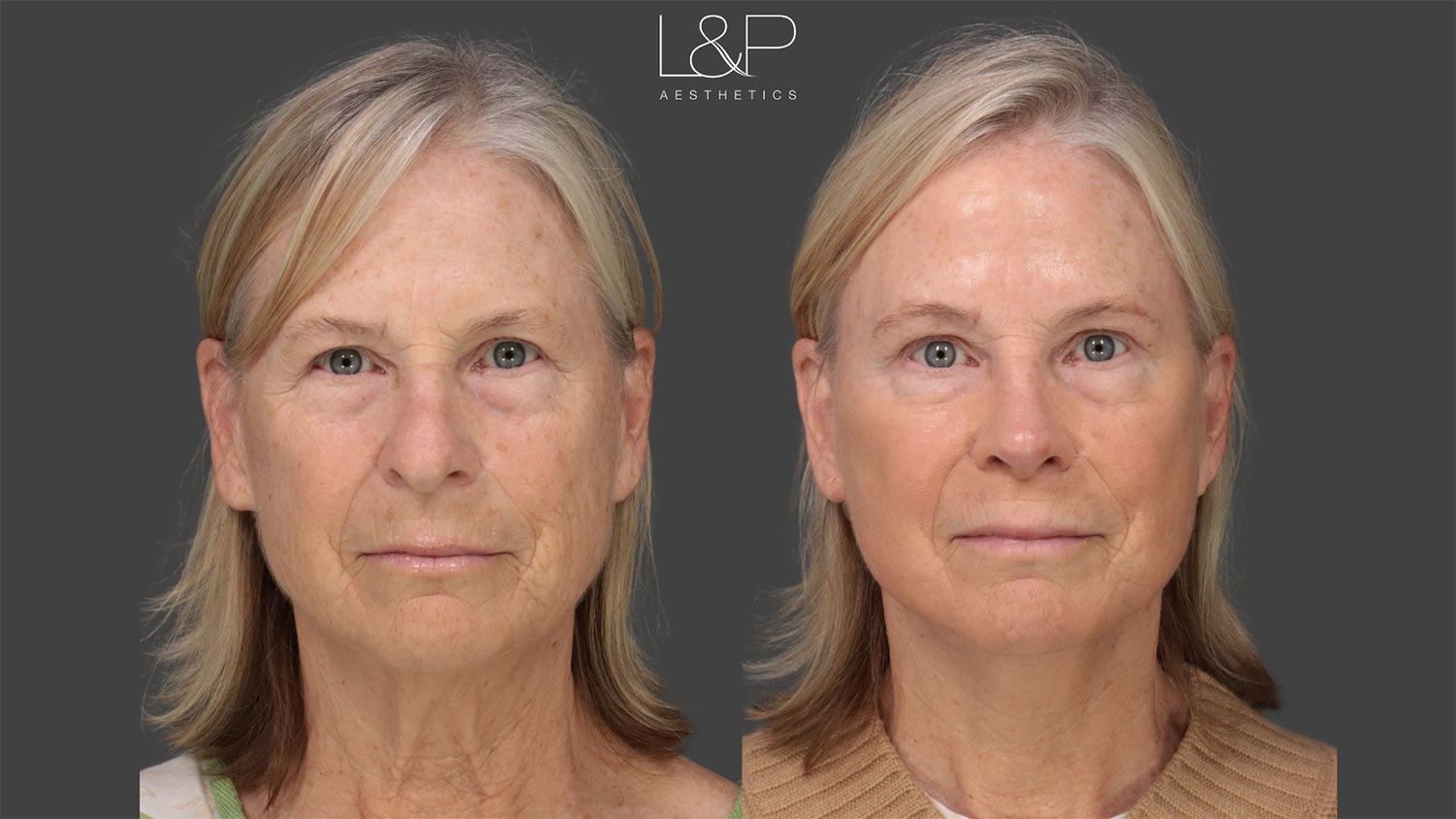 L&P Aesthetics facelift before and after images side by side