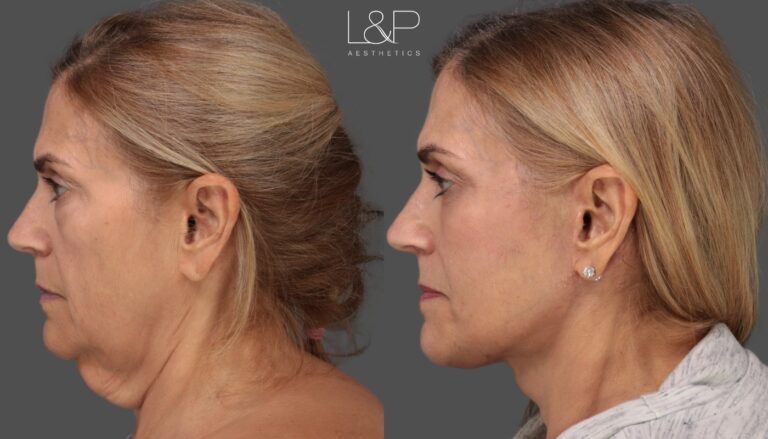 Woman with heavy neck before and after a facelift with Drs. L&P