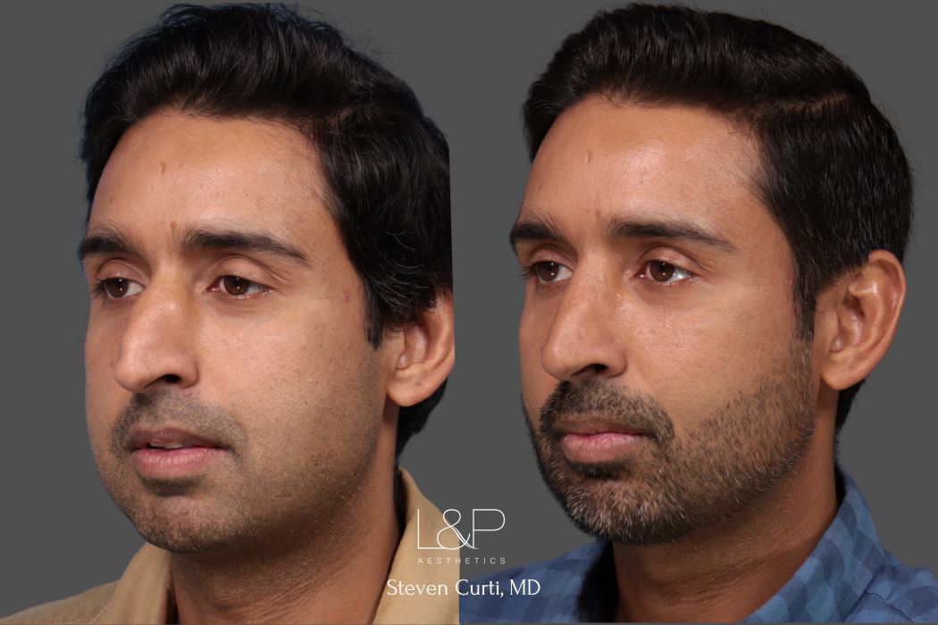 male rhinoplasty and buccal fat removal 3/4 view - L&P Aesthetics
