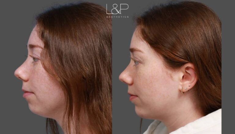 Female Chin Augmentation, Age 26 – Case 61