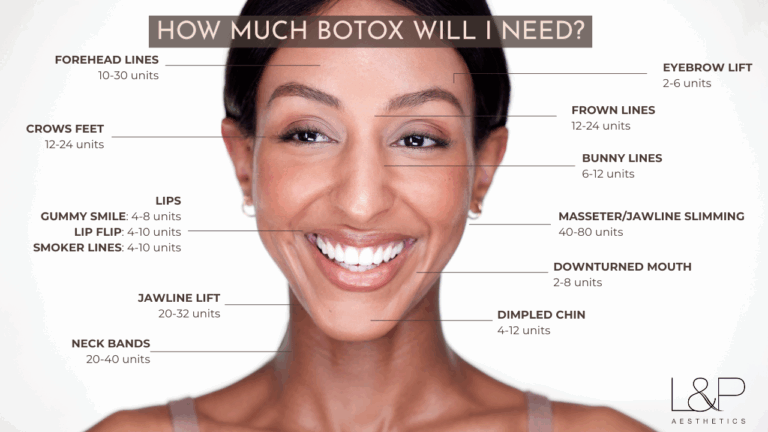 Botox Placement and Units Chart