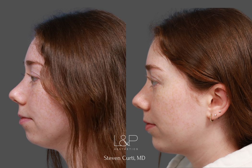 Chin implant by Dr. Curti at L&P Aesthetics