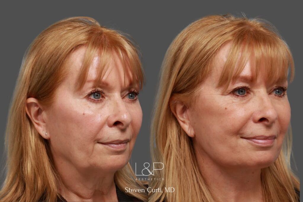 Woman with facelift by Dr. Steven Curti at L&P Aesthetics