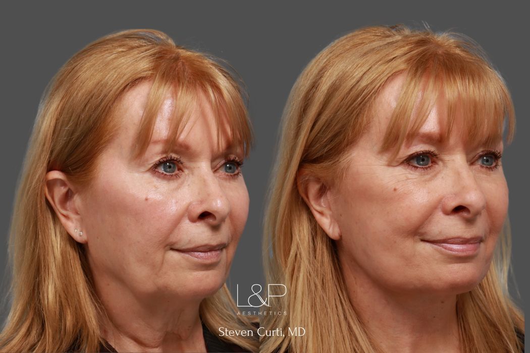 Woman with facelift by Dr. Steven Curti at L&P Aesthetics