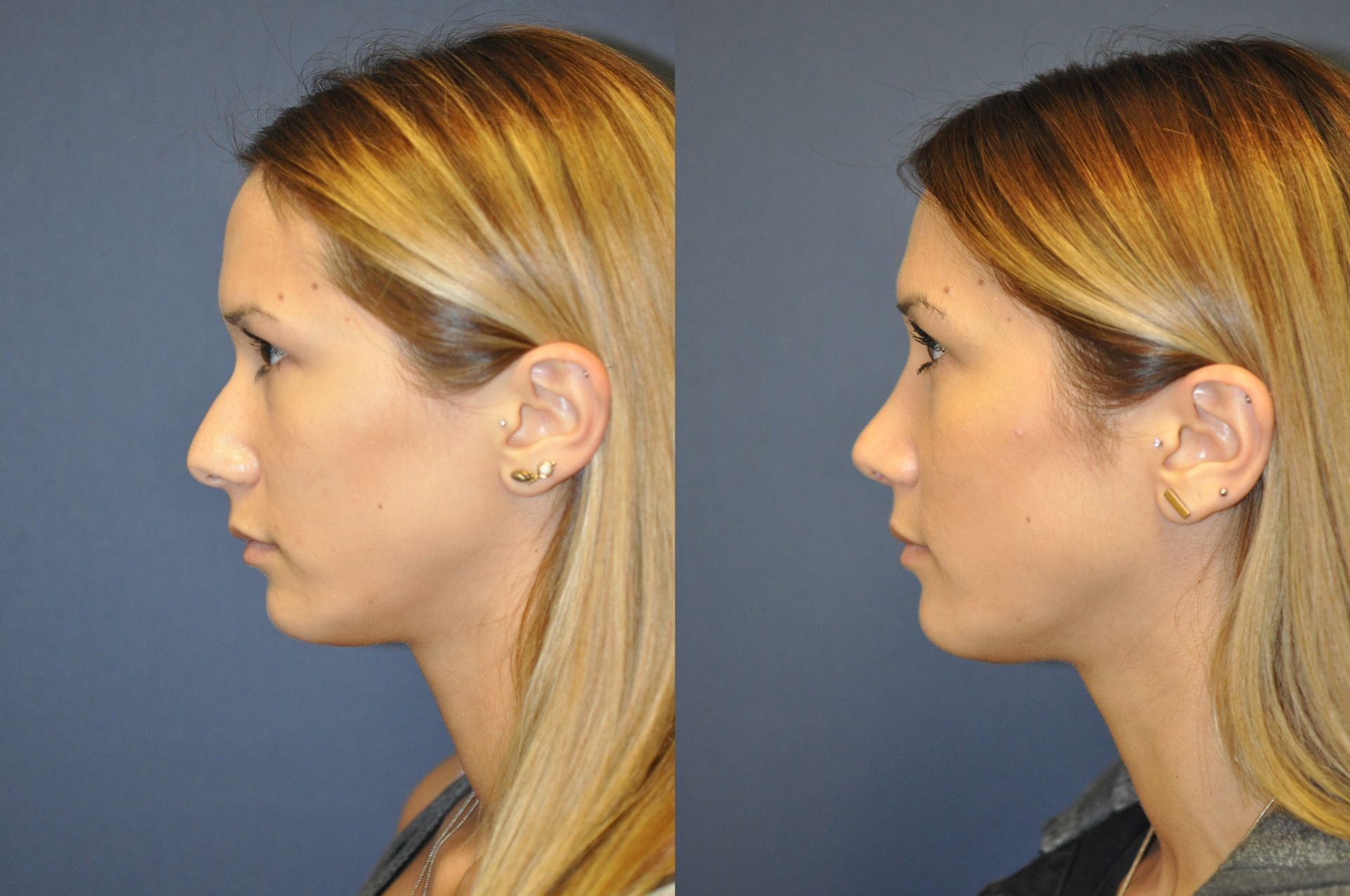 rhinoplasty Low, Lindsey (20140826093839856) 20150628115452695
