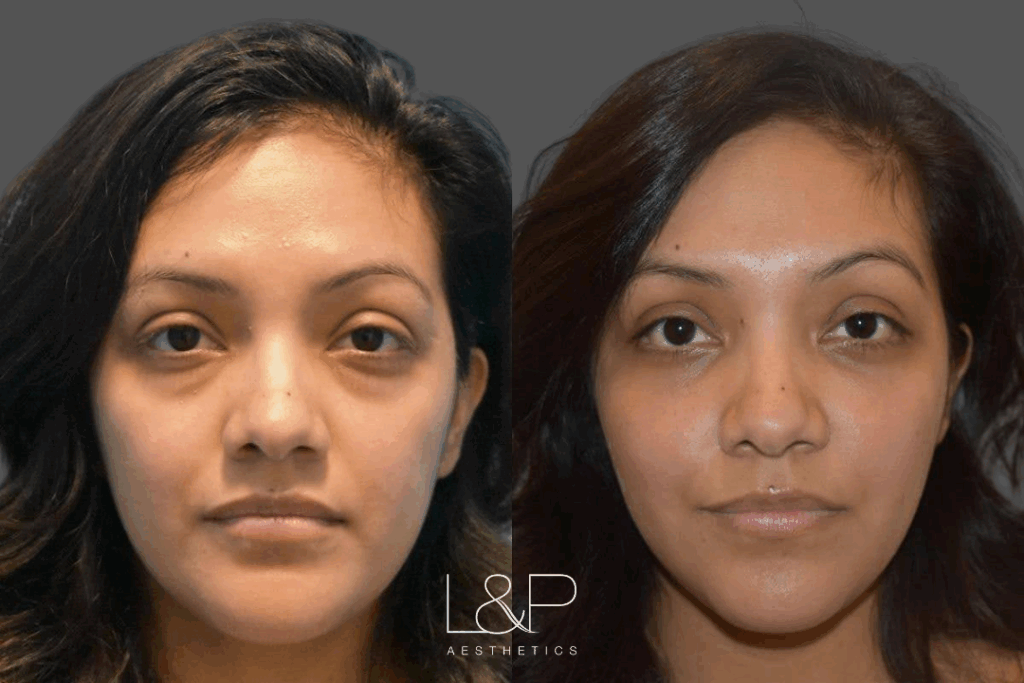 Before and after an upper and lower blepharoplasty at L&P Aesthetics