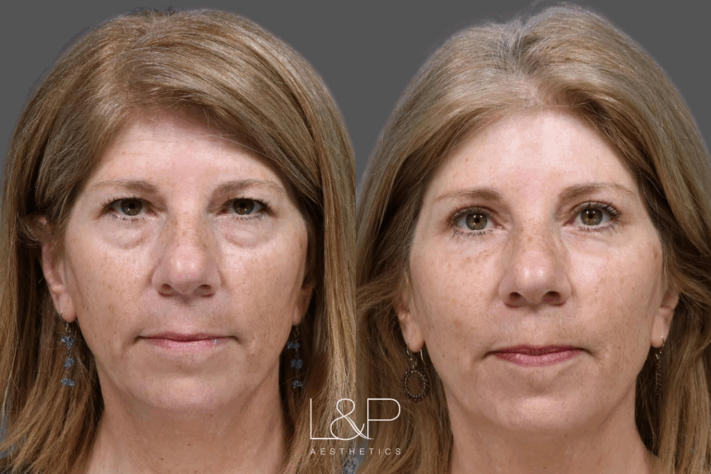 Before and after upper and lower blepharoplasty at L&P Aesthetics