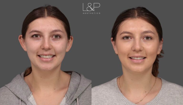 CC Otoplasty Palo Altopng