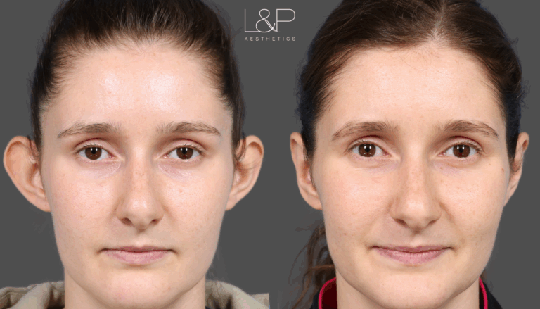 MC Otoplasty Palo Alto