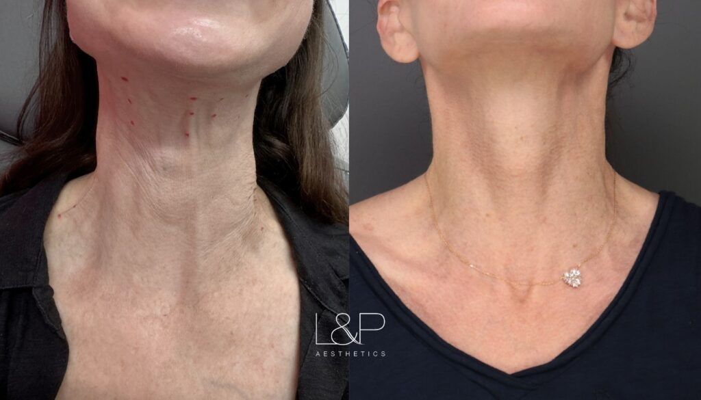 Before and After Laser Assisted Drug Delivery