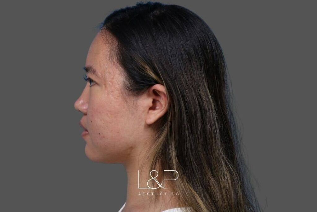 Acne scarring on a patient at L&P Aesthetics