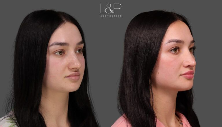 Curti Rhinoplasty 3
