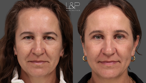 Female Blepharoplasty at 64 by L&P Aesthetics