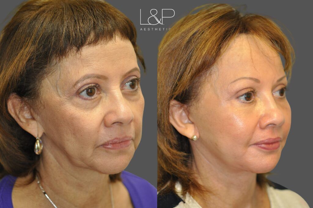 L&P Facelift, Necklift, Fat Transfer & Brow Lift, Case 38 - looking left oblique