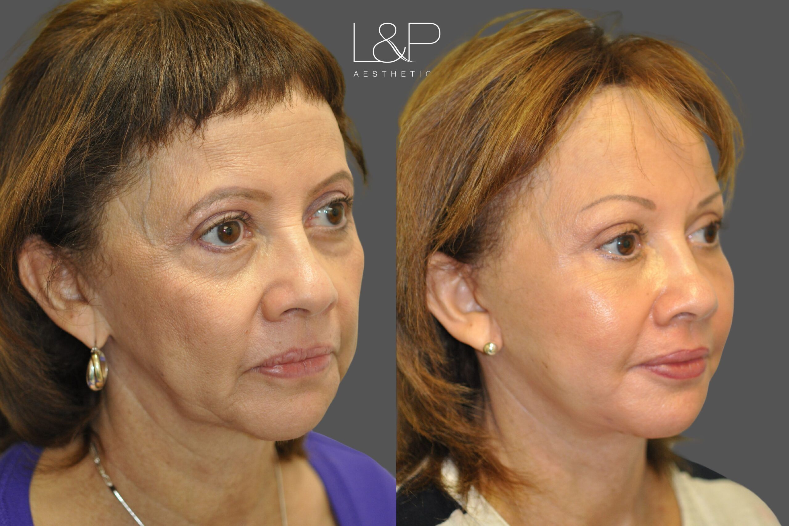 L&P Facelift, Necklift, Fat Transfer & Brow Lift, Case 38 - looking left oblique