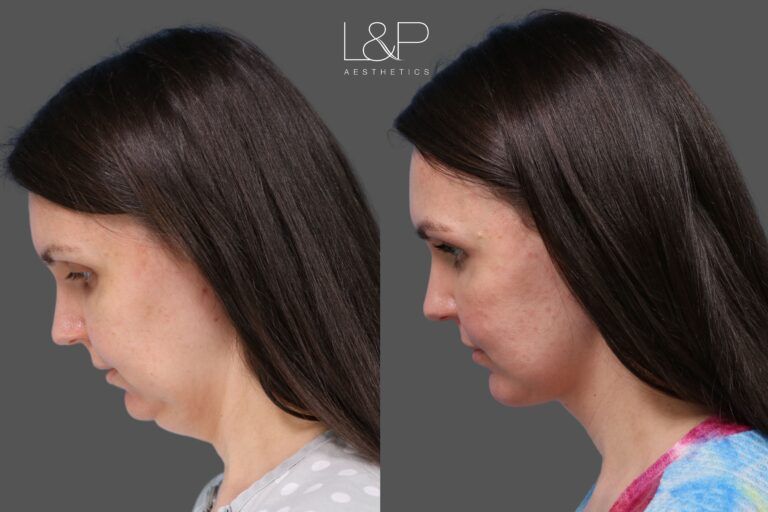 L&P Signature Facelift, Neck Lift, and Chin Augmentation, Case 187 - looking down