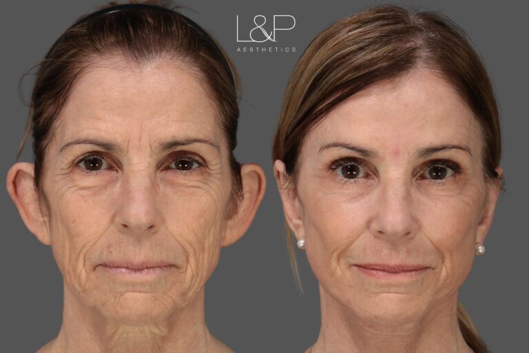 Facelift & otoplasty by Drs. Lieberman and Parikh - facing front