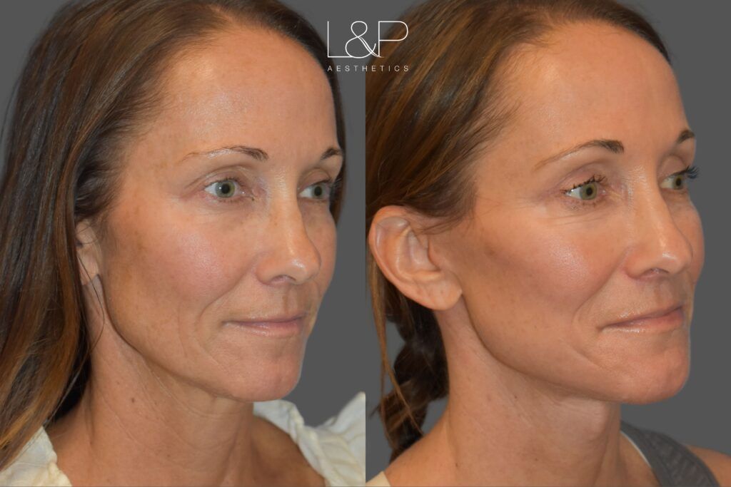 L&P Face Lift for Lovely Woman, Case 21 - looking left oblique
