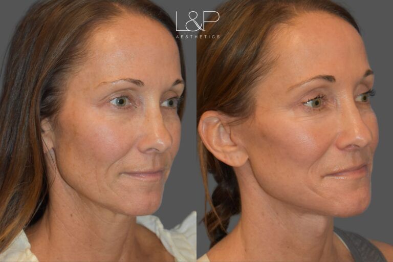 L&P Face Lift for Lovely Woman, Case 21 - looking left oblique
