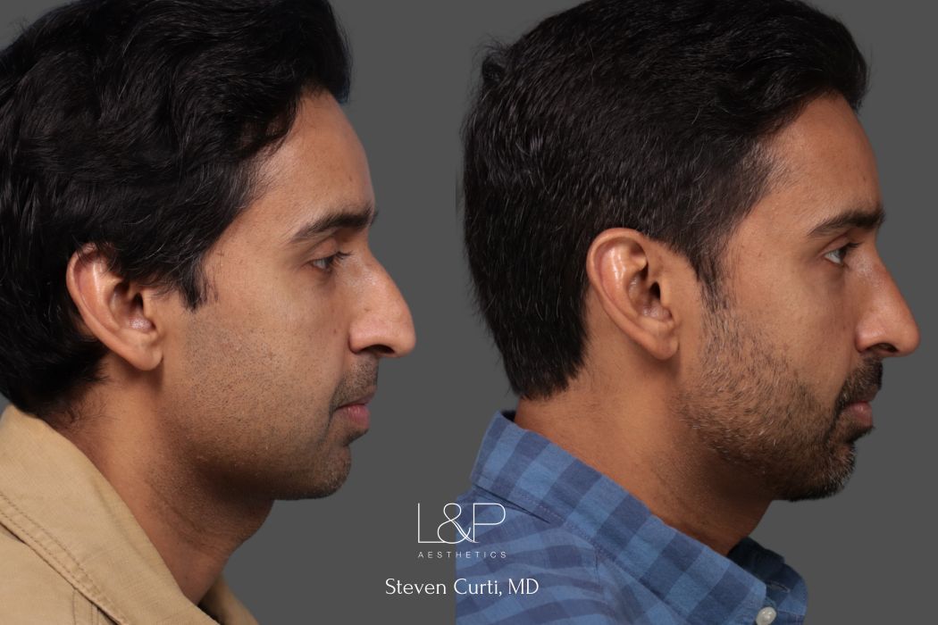 male rhinoplasty and buccal fat removal left side view - L&P Aesthetics