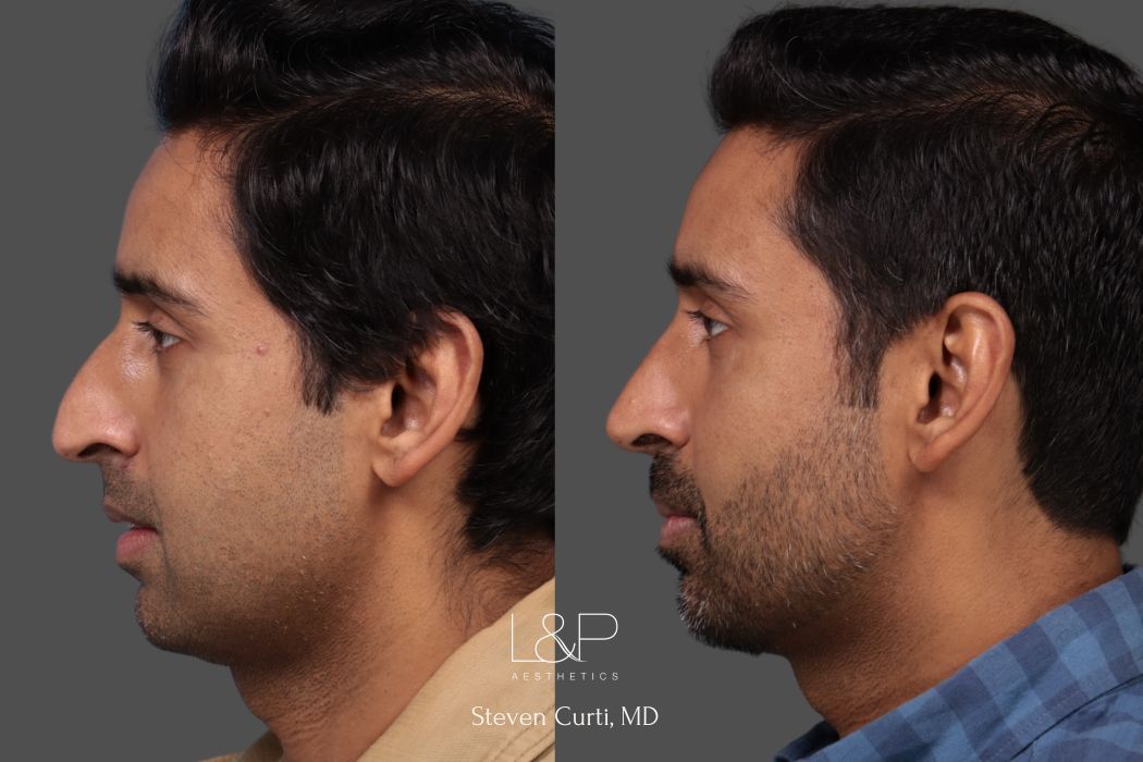 male rhinoplasty and buccal fat removal right side view - L&P Aesthetics